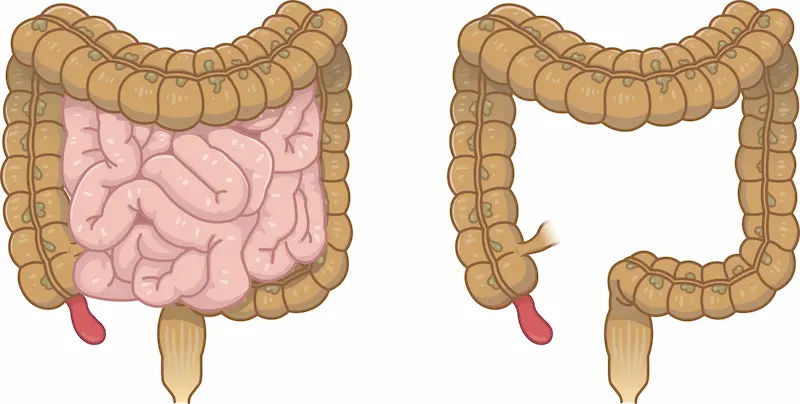 Understanding Appendicitis Symptoms, Causes, and Treatment